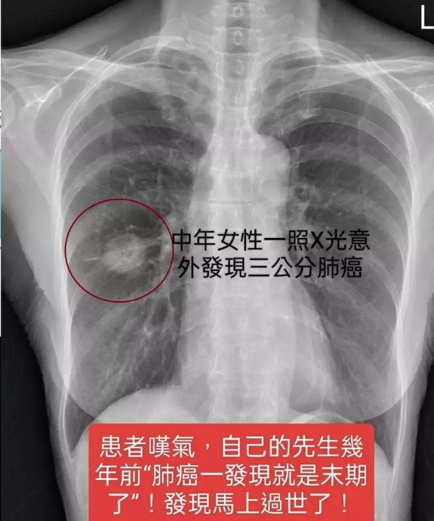 蘇一峰指出,有一對夫妻都罹患肺癌,原因是丈夫是重度吸菸者,且還常常在家中吸菸。